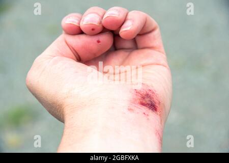 Rote Wunde an Handfläche, Hand, Handgelenk nach einem Brand oder Sturz, Nahaufnahme. Erste Hilfe bei der Wundbehandlung. Behandlung von Wunden Stockfoto