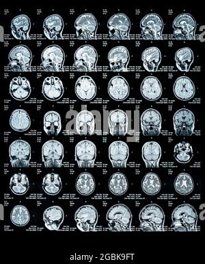 MRT Scan-Bild eines menschlichen Gehirns mit allen wichtigen Details der Multiplen Sklerose Stockfoto