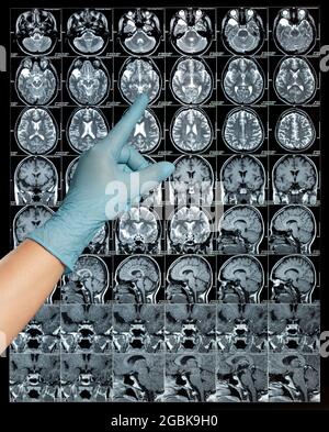 MRT-Hirnscan oder Magnetresonanzbild Ergebnisse, Neurologie zeigen einen Finger Stockfoto
