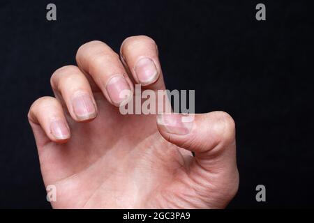 Nahaufnahme der weiblichen kaukasischen Hand mit schmutzigen brüchigen Nägeln, gebrochene Nägel auf schwarzem Hintergrund. Peeling auf den Nägeln. Nagel- und Handpflegekonzept Stockfoto