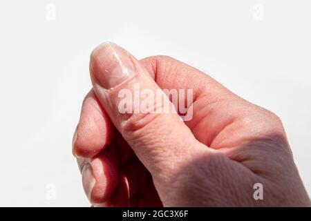 Nahaufnahme eines weiblichen Daumens mit einer weichen Fossa auf einem Nagel, einer überwucherten Nagelhaut, einer abblätternden Nagelschicht, schlechter Maniküre auf hellem Hintergrund. Ungesunde Nai Stockfoto