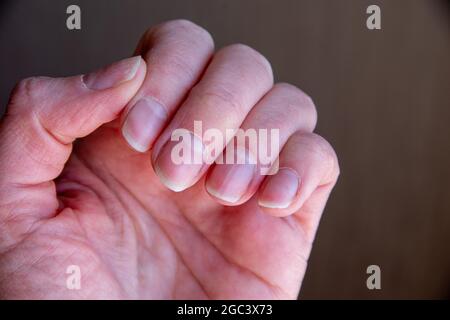 Nahaufnahme der weiblichen Nägel nach einer schlechten Maniküre auf braunem Hintergrund. Nagelhaut überwuchert Nägel und beschädigte Nagelplatte. Gesundheits- und Pflegekonzept Stockfoto