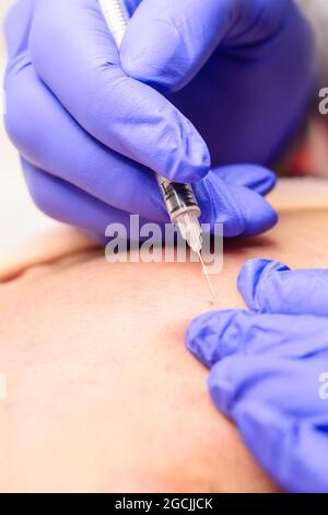 Milien im Gesicht, Entfernung von verhärteten und reifen Milien durch eine Kosmetikerin. Neu Stockfoto