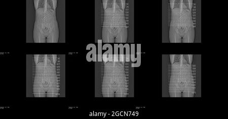 Die Scout-Ansicht (Topogramm) für eine CT des Abdomens und Beckens mit intravenösem Kontrast. Referenzbilder für die Aufnahme einer axialen CT-Serie. Stockfoto