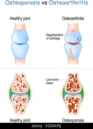 Osteoporose vs. Arthrose. Vergleich und Unterschied zwischen gesunder Gelenkerkrankung und degenerativer Knorpelerkrankung und Gelenk mit geringer Knochenmasse Stock Vektor