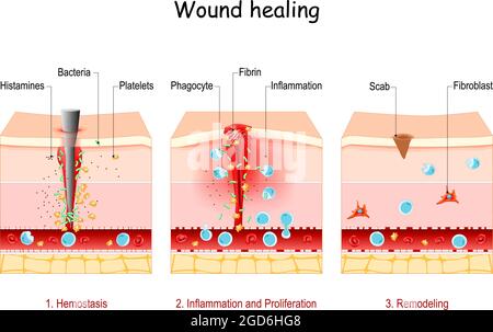 Wundheilung. Phasen des Post-Trauma-Reparaturprozesses. Hämostase, entzündliche, proliferative und Remodeling-Phase. Querschnitt Stock Vektor