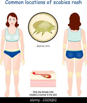 Häufige Standorte von Krätze Ausschlag. Nahaufnahme der Scabies Milbe. Vergrößerung des Querschnitts der Hautschichten Stock Vektor