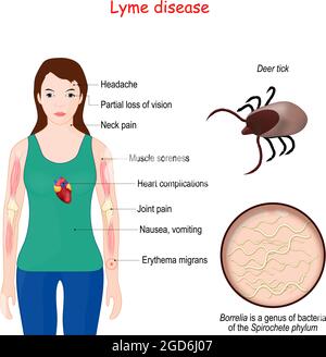 Lyme-Borreliose. Nahaufnahme des Hirschticks. Vergrößerung von Borrelien (Bakterien des Spirochetenphylums). Frau mit Erythem, Anzeichen und Symptomen Stock Vektor