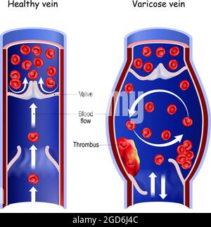 Gesunde Vene und Krampfader. Querschnitt von normalem Blutgefäß und Thrombus im Blutfluss. vektordarstellung Stock Vektor