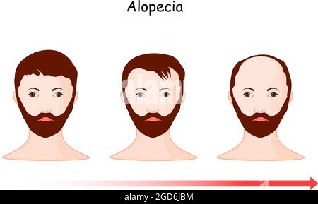 Alopezie. Haarausfall. Haarausfall von einem Teil des Kopfes eines Mannes entlang der Zeit. vektor-Illustration menschlichen Kopf und Zeitlinie Stock Vektor