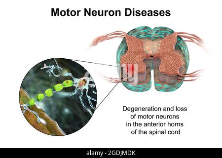Erkrankungen der Motoneurone, Illustration Stockfoto