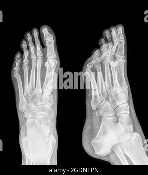 Die Röntgenaufnahme eines Fußes, die eine Plantar-Fasziitis (auch bekannt als Plantar-Fasziopathie oder Jogger-Ferse) zeigt, ist eine häufige schmerzhafte enthesopathische Erkrankung der Ferse und der Planta Stockfoto
