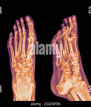 Die Röntgenaufnahme eines Fußes, die eine Plantar-Fasziitis (auch bekannt als Plantar-Fasziopathie oder Jogger-Ferse) zeigt, ist eine häufige schmerzhafte enthesopathische Erkrankung der Ferse und der Planta Stockfoto