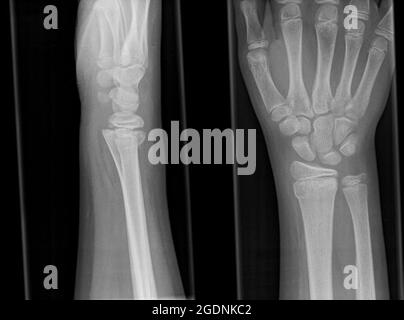 Röntgenaufnahme der rechten Hand eines 13-jährigen Mannes, die eine Fraktur des distalen Radius zeigt Stockfoto