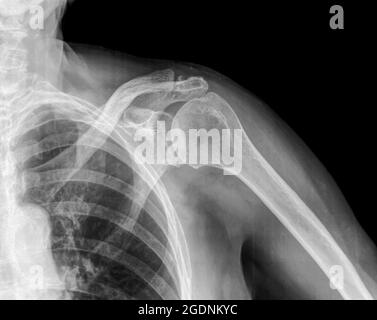 Röntgenaufnahme einer linken Schulter eines 89-jährigen männlichen Patienten Stockfoto