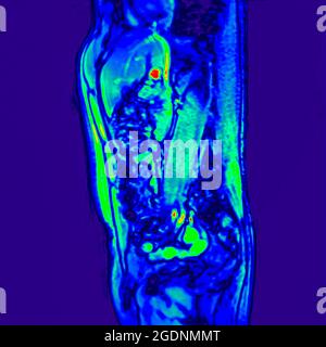 Seitenansicht Abdomen MRI-Scan eines 60 Jahre alten männlichen Patienten. Dieser Patient leidet an einem nierenstein Stockfoto