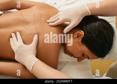 Akupunktur für den Rücken einer asiatischen Frau in einer traditionellen chinesischen medizinischen Klinik. Blick von oben Stockfoto