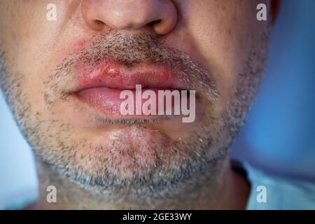 Herpes-Virus-Infektion bei einem Mann auf den Lippen. Medizinische Versorgung Foto Stockfoto