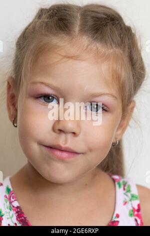 Porträt des kaukasischen kleinen Mädchens von fünf Jahren mit anschwellenden Augen wegen Allergie, Bindehaut und Adenoiden auf weißem Hintergrund Stockfoto