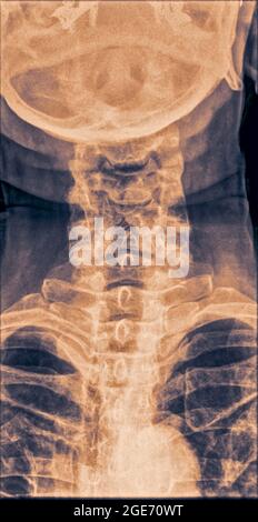 Normale Röntgenaufnahme der Halswirbelsäule einer 70-jährigen Patientin. Vorderansicht Stockfoto
