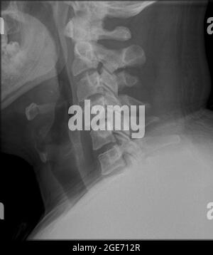 X-ray von einem menschlichen Hws Seitenansicht Stockfoto