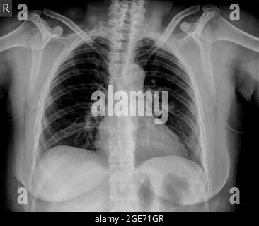 Thorax-Röntgenaufnahme einer einjährigen Frau mit Lungenentzündung. Vorderansicht Stockfoto