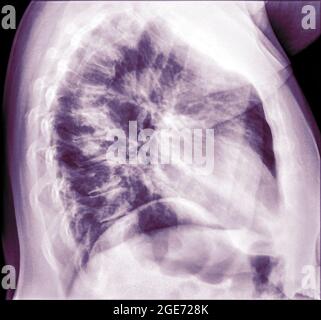 Thorax-Röntgenaufnahme einer 57-jährigen Patientin mit Anzeichen einer Lungenentzündung im rechten Unterlappen (RLL) ihrer Lungenseitenansicht Stockfoto