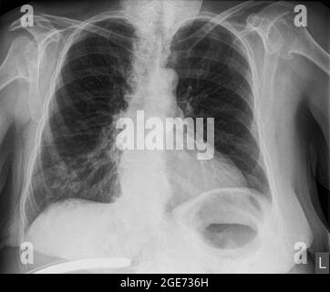 Thorax-Röntgenaufnahme einer 57-jährigen Patientin mit Anzeichen einer Lungenentzündung im rechten Unterlappen (RLL) ihrer vorderen Lungenansicht Stockfoto