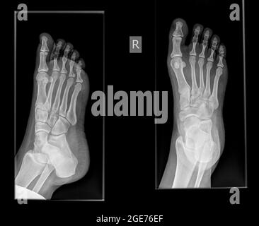 X-ray von einem Fuß einen Bruch in der proximalen Phalanx der Großzehe auf dem righ Fuß einer 30 Jahre alten Patientin Stockfoto