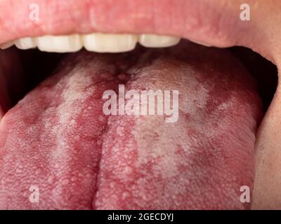 Zunge mit Stomatitis Nahaufnahme, Mundkrebs. Stockfoto