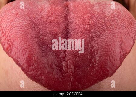 Risse in der Zunge Candida Krankheiten, rote Zunge Stomatitis Nahaufnahme. Stockfoto