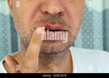 Der Mensch trägt eine Creme auf Herpes-Virus-Infektion auf der Lippe mit seinem Finger. Medizinische Versorgung Foto Stockfoto