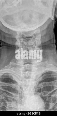 Normale Röntgenaufnahme der Halswirbelsäule einer 70-jährigen Patientin. Vorderansicht Stockfoto