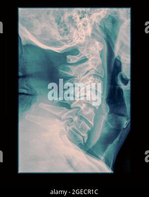 Hws x-ray mit einem zerbrochenen Dens. Ein 50 Jahre alter männlicher Patient Seitenansicht Stockfoto