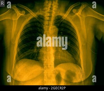 Thorax-Röntgenaufnahme einer einjährigen Frau mit Lungenentzündung. Vorderansicht Stockfoto