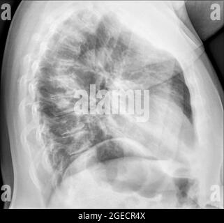 Thorax-Röntgenaufnahme einer 57-jährigen Patientin mit Anzeichen einer Lungenentzündung im rechten Unterlappen (RLL) ihrer Lungenseitenansicht Stockfoto