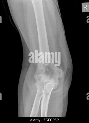 X-Ray von einem gebrochenen Ellbogen (Humerus Knochen) der eine 70 Jahre alte weibliche Patienten Vorderansicht Stockfoto