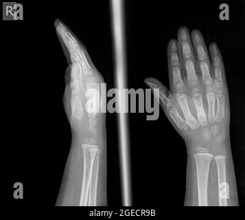 Röntgenaufnahme des Handgelenks und der Hand einer 2-jährigen Patientin mit 2 und 3 Metacarpalfrakturen Stockfoto