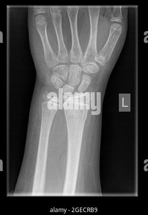 Handgelenk eines 9 Jahre alten männlichen Patienten mit distalem Radius und Ulna-Frakturen Stockfoto