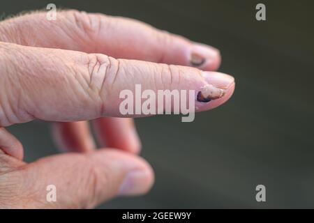 Älterer Mann, der ein heilendes Weichteiltrauma mit abgestorbener Haut und Anzeichen von subkutanen Blutungen an seinen Fingern in Nahaufnahme zeigte Stockfoto