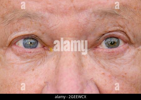 Extreme Nahaufnahme der Augen eines älteren Mannes mit Augenkrankheit, die eine ungleiche Pupillenerweiterung zeigt Stockfoto
