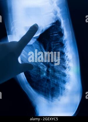 Ergebnis des Röntgenscans der Lungenrippen. Stockfoto