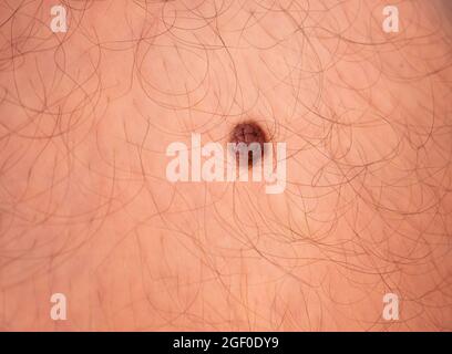 Nahaufnahme von Nevus. Makroaufnahme. Stockfoto