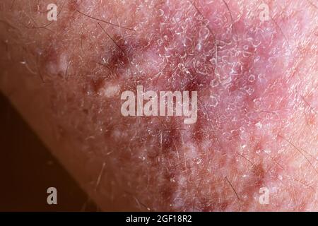 Flechten planus auf Beinhaut Nahaufnahme. Dermatologische Erkrankung in Form von roten Flecken, Ausschlägen und juckender Hautoberfläche. Stockfoto