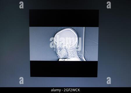 Bild der Computertomographie des Gehirns aus nächster Nähe Stockfoto