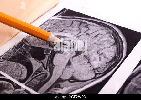 MRT-Bild des Gehirns auf Papier Nahaufnahme Stockfoto