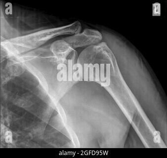 Schulter Röntgen eines 40 Jahre alten männlichen Patienten mit einem gebrochenen Schlüsselbein-Vorderansicht Stockfoto