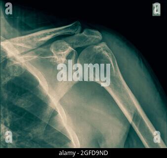 Schulter Röntgen eines 40 Jahre alten männlichen Patienten mit einem gebrochenen Schlüsselbein-Vorderansicht Stockfoto