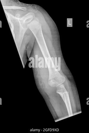 Supracondylar Fracture im Humerus einer 2-jährigen Patientin ist die Supracondylar Fraktur des Humerus eine Fraktur des distalen Endes des Stockfoto