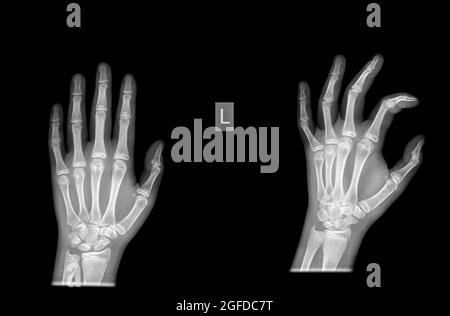 Radius distale Fraktur bei einer 13 Jahre alten Patientin Stockfoto